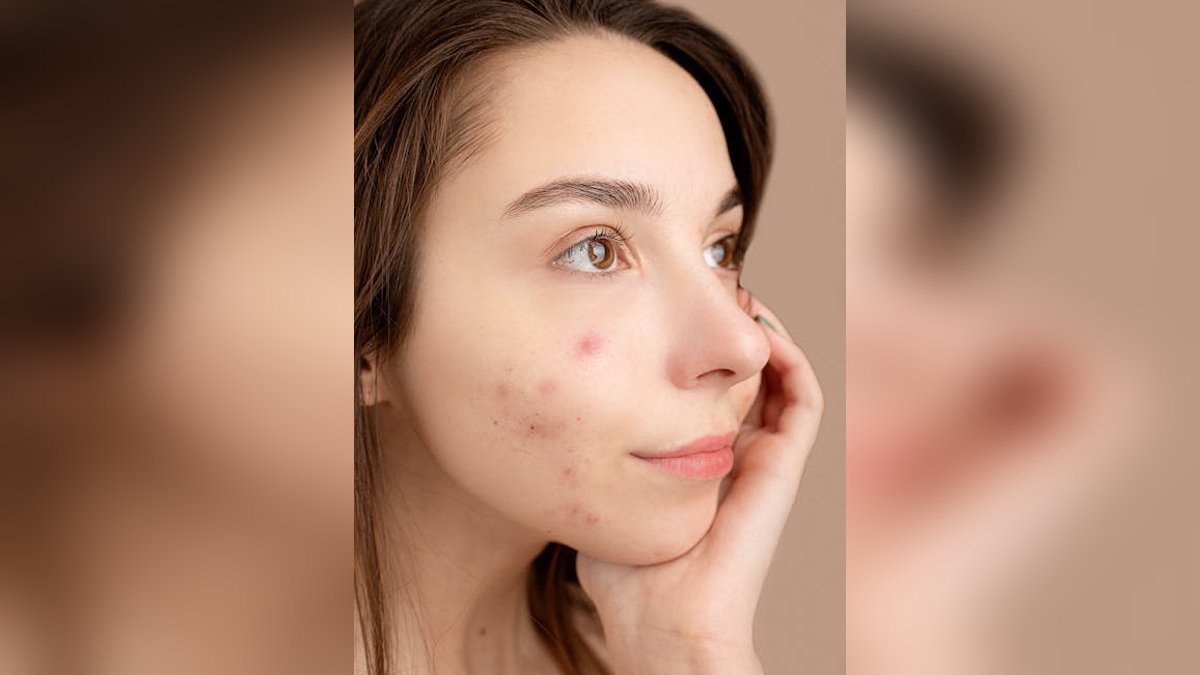 Does Diet Cause Acne