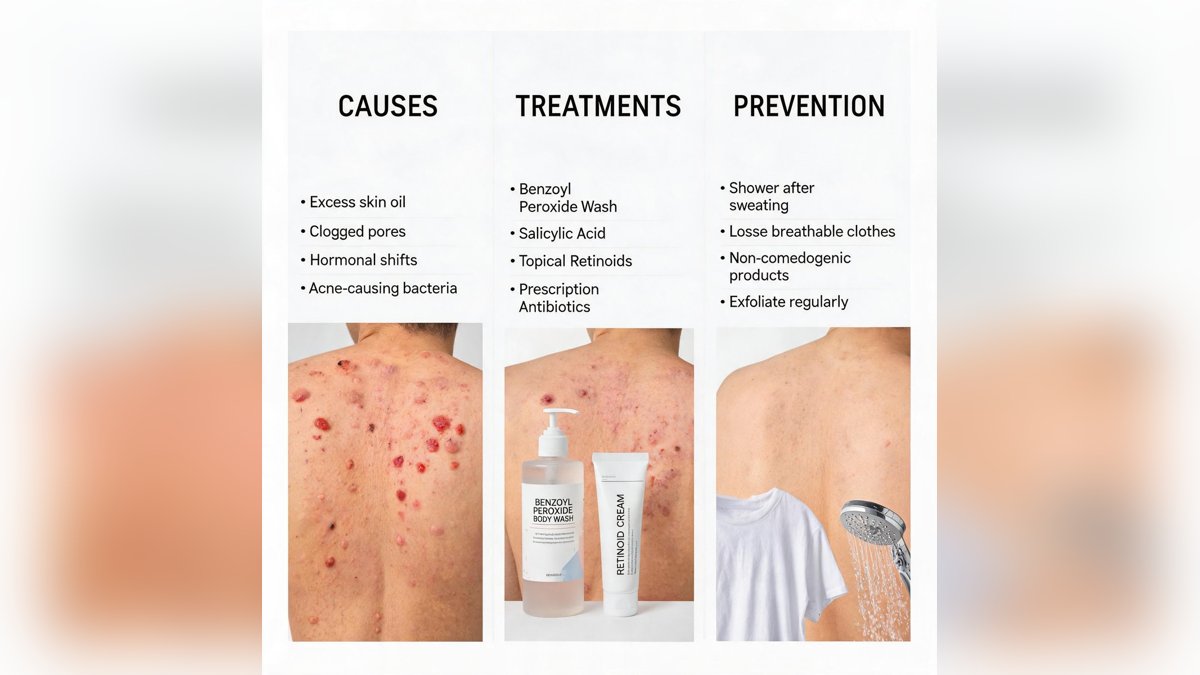 Body Acne: Causes, Treatments, and Prevention Strategies — Glow Guide